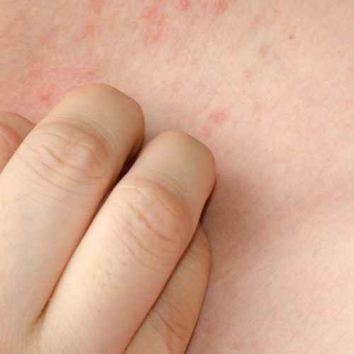 Psoriasis por estres